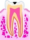 虫歯の状態：C1