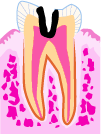 虫歯の状態：C3