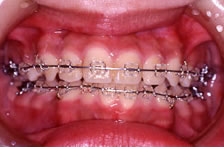 歯科矯正装置：セラミック