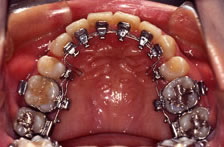 歯科矯正装置：リンガル